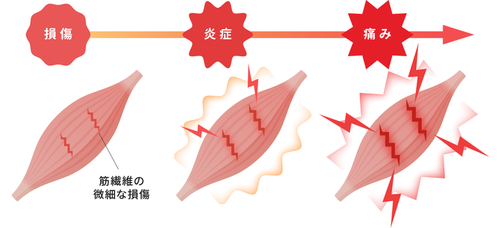 筋肉痛のメカニズム：損傷、炎症、痛みの図