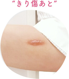 切り傷跡
