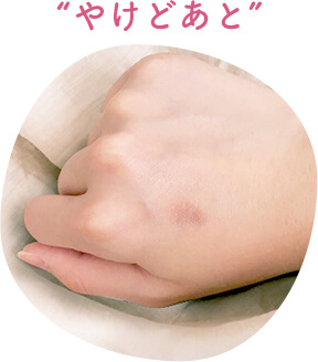火傷(やけど)跡
