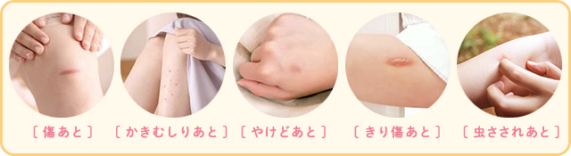 いろいろな傷跡(きずあと)