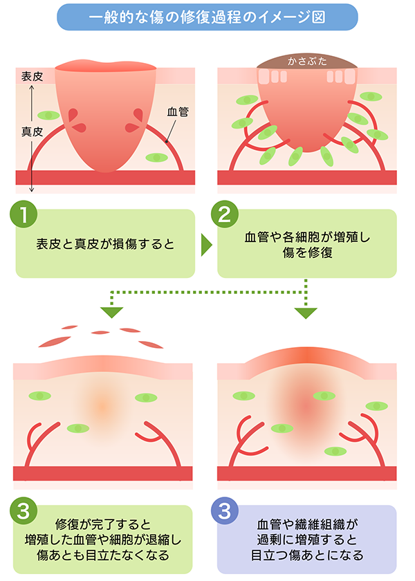 一般的な傷の修復過程のイメージ図