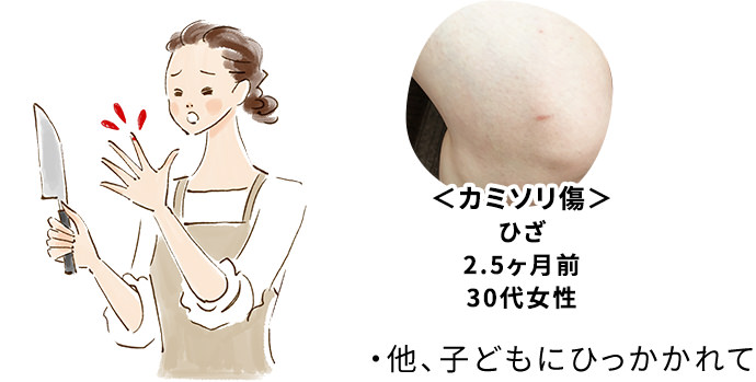 カミソリ傷
