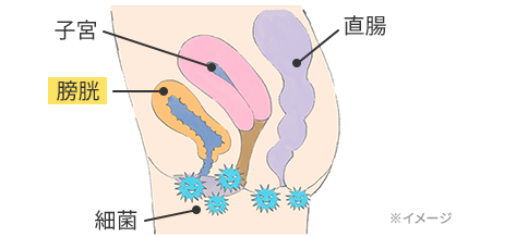 膀胱炎の原因イメージ