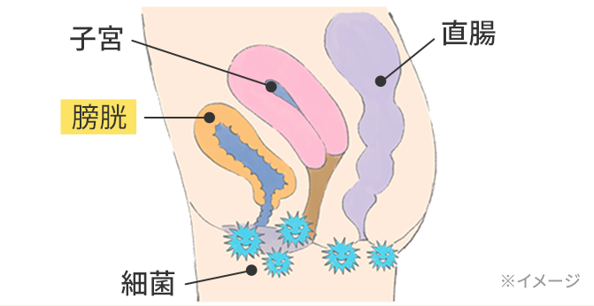 膀胱炎の原因イメージ
