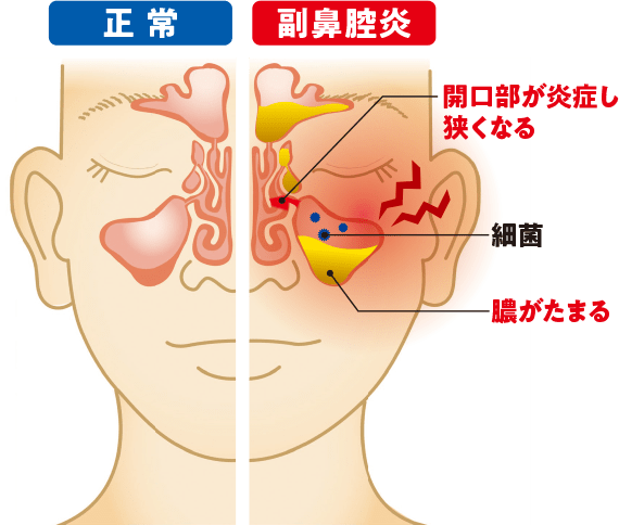左図：正常 右図：副鼻腔炎 開口部が炎症し狭くなる 副鼻腔に細菌が侵入し膿がたまる