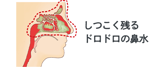 しつこく残るドロドロの鼻水