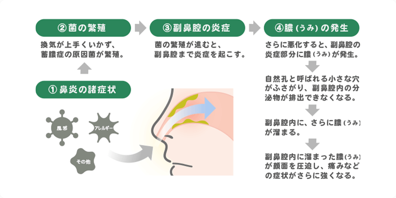 ①鼻炎の諸症状 ②菌の繁殖 換気が上手くいかず、蓄膿症の原因菌が繁殖 ③副鼻腔の炎症 菌の繁殖が進むと、副鼻腔まで炎症を起こす。 ④膿(うみ)の発生 さらに悪化すると、副鼻腔の炎症部分に膿(うみ)が発生。 自然孔と呼ばれる小さな穴がふさがり、副鼻腔内の分泌物が排出できなくなる。 副鼻腔内に、さらに膿(うみ)が溜まる。 副鼻腔内に溜まった膿(うみ)が顔面を圧迫し、痛みなどの症状がさらに強くなる。