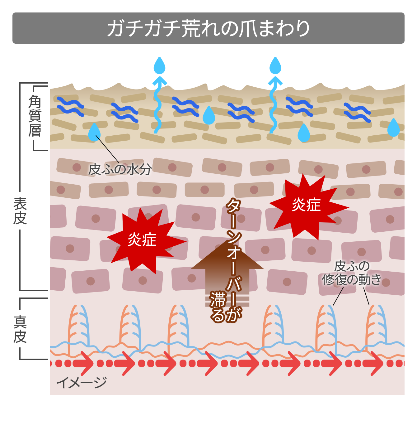 ガチガチ荒れの爪まわりの皮ふ 簡略図