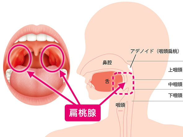 扁桃 炎 首 の 後ろ が 痛い