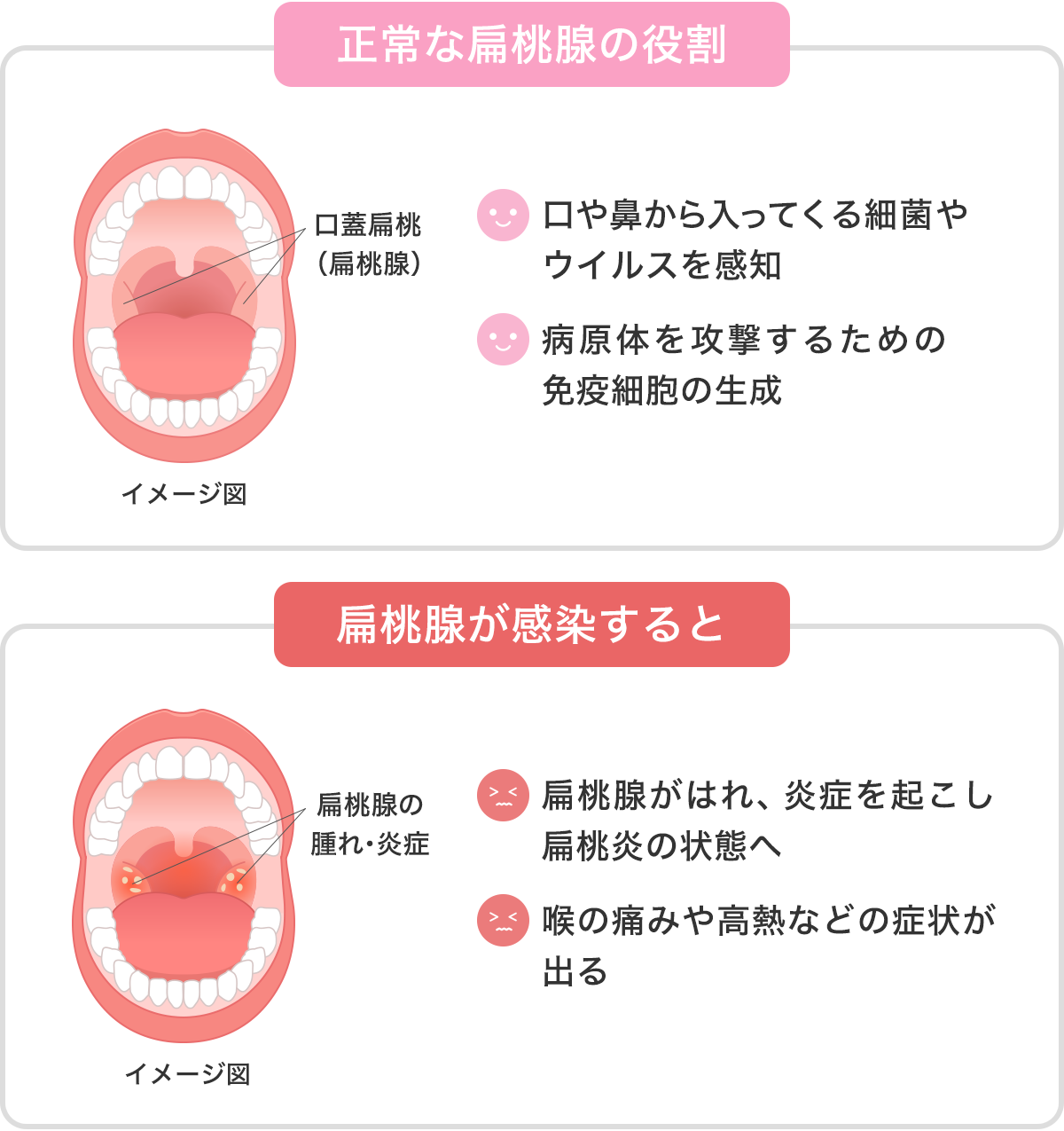 正常な扁桃腺の役割と扁桃腺が感染した時のイメージ図