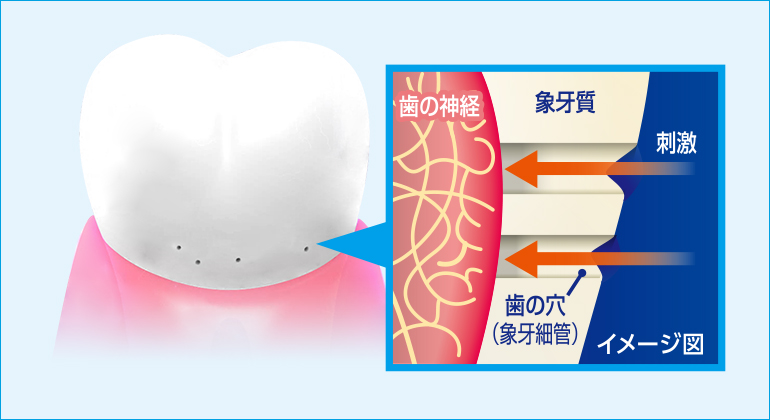 歯の穴イメージ図