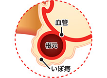 【医師監修】繰り返すいぼ痔の原因は？