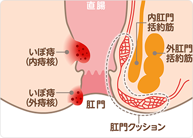 お尻の構造（いぼ痔の状態）