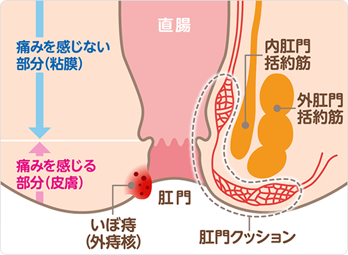 外痔核