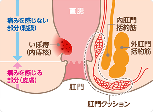 内痔核