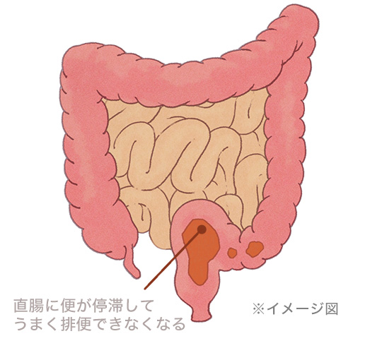 �����ɕւ���؂��Ă��܂��r�ւł��Ȃ��Ȃ遦�C���[�W�}