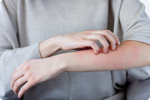 『湿疹』 イメージ写真