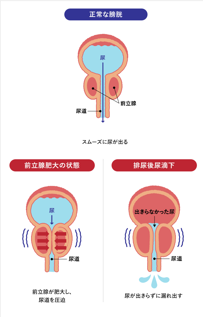 正常な膀胱はスムーズに尿が出る,前立腺肥大の状態は前立腺が肥大し、尿道を圧迫,排尿後尿滴下は尿が出きらずに漏れ出す