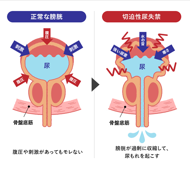 正常な膀胱は腹圧や刺激があってもモレない,切迫性尿失禁は膀胱が過剰に収縮して、尿もれを起こす