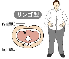 リンゴ型肥満