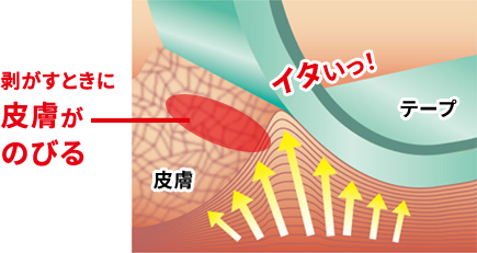 剥がすときに皮膚がのびる