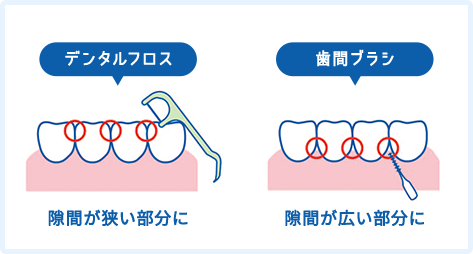 「デンタルフロス」と「歯間ブラシ」の違い