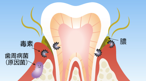 歯ぐき臭のイメージ