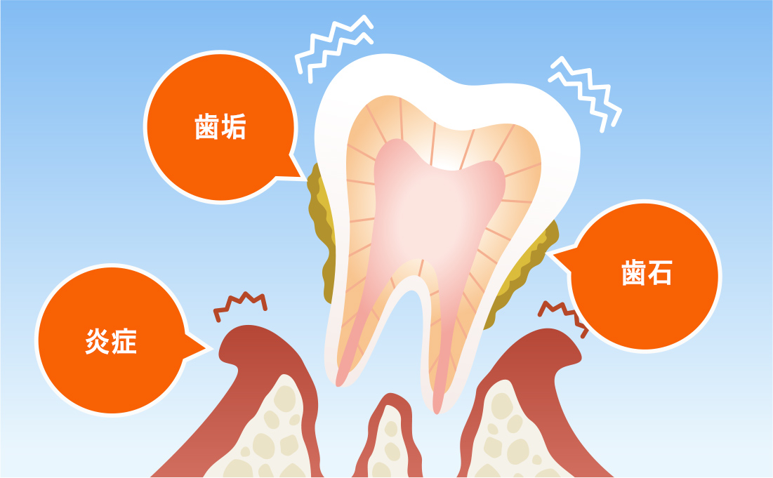 歯槽膿漏とは