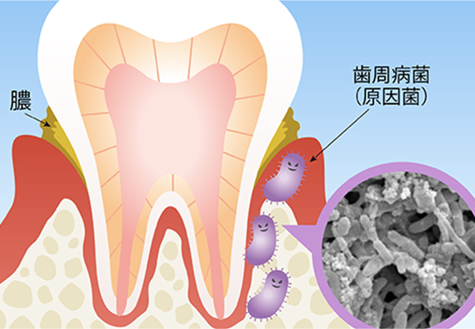 歯槽膿漏の原因