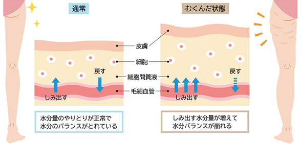 通常 水分量のやりとりが正常で水分のバランスが取れている むくんだ状態 しみ出す水分量が増えて水分バランスが崩れる