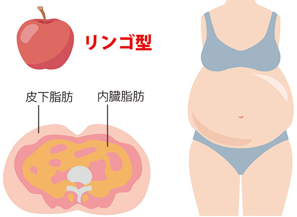 リンゴ型 皮下脂肪 内臓脂肪型肥満