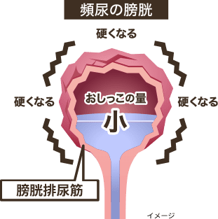 頻尿の膀胱