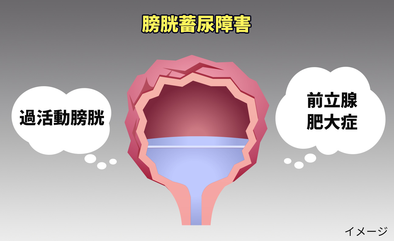 夜間頻尿を引き起こす膀胱蓄尿障害の原因：過活動膀胱、前立腺肥大など