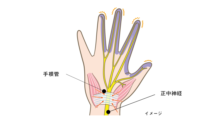 手根管症候群のメカニズム（イメージ）