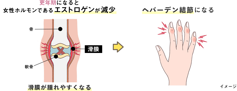 更年期になると女性ホルモンであるエストロゲンが減少し、滑膜が腫れやすくなることで、へバーデン結節に繋がる