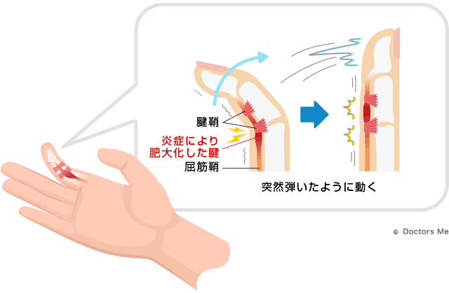 ばね指のメカニズム（イメージ）