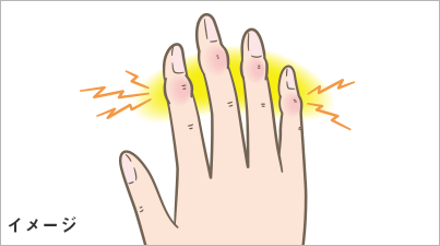 手指の病気について ユービケア 小林製薬