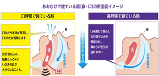 口呼吸は、口・のどの乾燥といびきの音が大きくなる原因のひとつです。