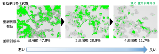 図5　ふきとり化粧水の連用による重層剥離率の変化（著効例）