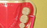 歯間ブラシ（L字型）の特徴