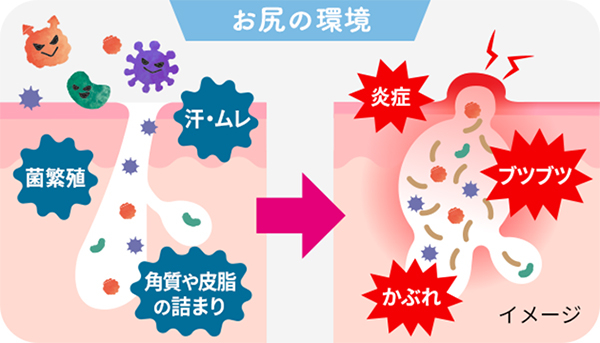 お尻にブツブツができるメカニズムを解説のイメージ画像