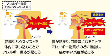 のどがかゆく・痛くなるメカニズムのイメージ画像