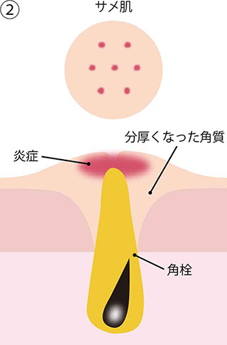 ②サメ肌