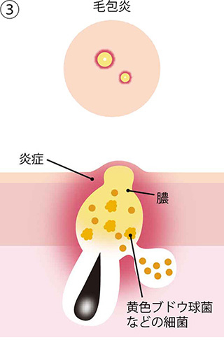 ③毛包炎