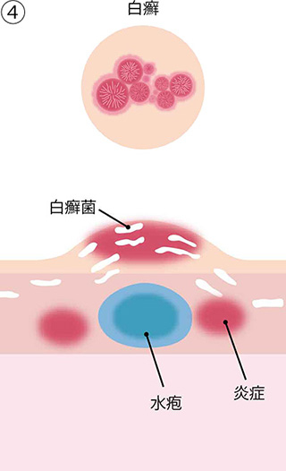 ④白癣