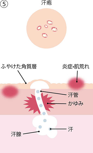 ⑤汗疱