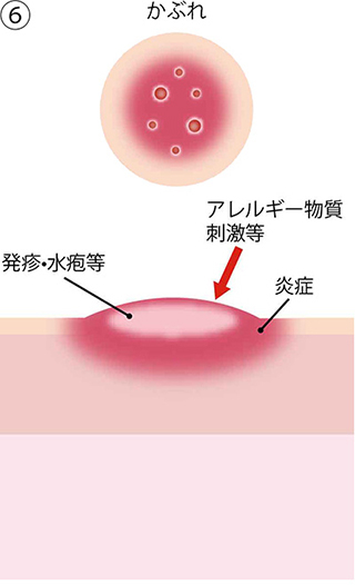 ⑥かぶれ