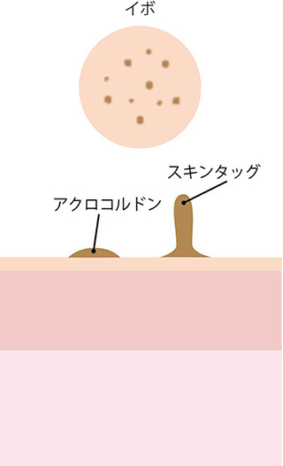 イボ