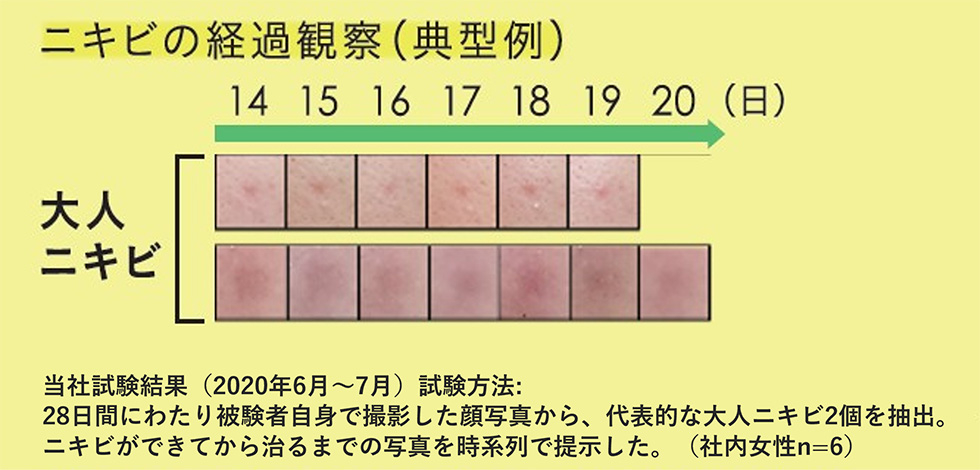 ニキビの経過観察