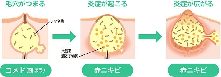 本格的なニキビができるまでのメカニズム